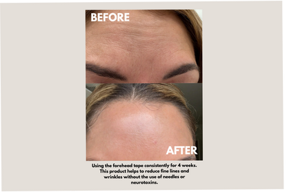 Seald™ Forehead Tape – Wrinkle Smoothing Patches